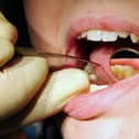 NHS Digital figures show around 535 admissions for children who needed teeth removed in the former NHS Wigan Borough CCG area — up on 380 the year before