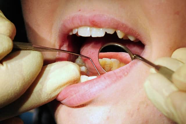 NHS Digital figures show around 535 admissions for children who needed teeth removed in the former NHS Wigan Borough CCG area — up on 380 the year before