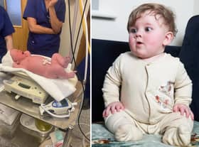 Teddie Eden just after being born (L) and pictured March 9, 2023 (R)