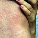 There has been a worrying increase in North West measles cases in recent weeks