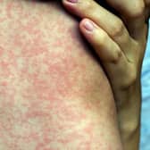 There has been a worrying increase in North West measles cases in recent weeks