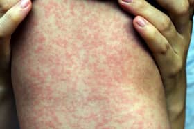 There has been a worrying increase in North West measles cases in recent weeks