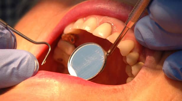 Luke now has a hole in his wallet after paying to repair the hole in his tooth