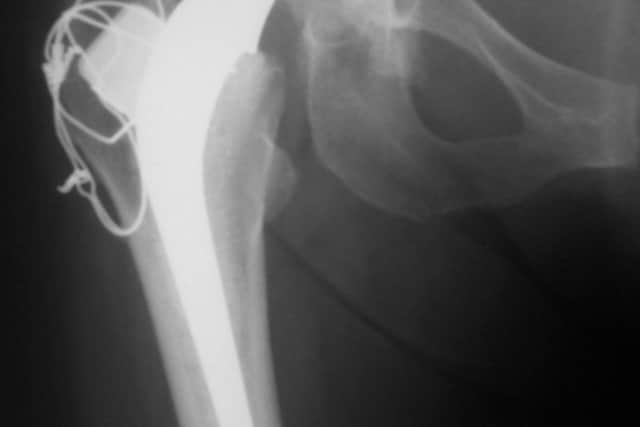 Successful two component hip joint