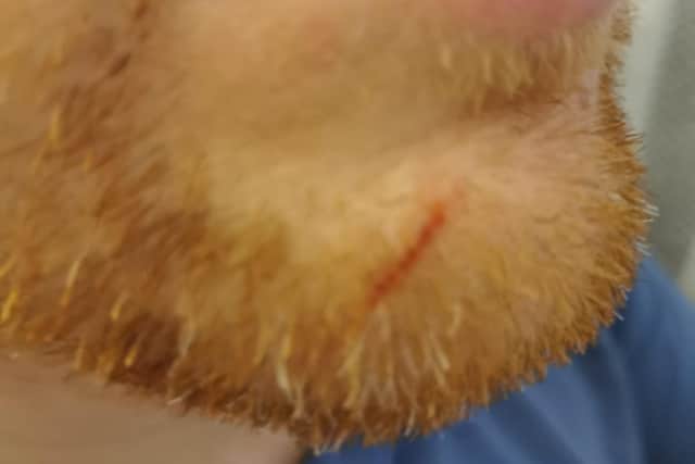 An injury on Stuart's chin after the attack