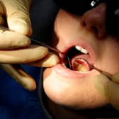 Figures from the Office for Health Improvement and Disparities show there were an estimated 675 total hospital admissions in Wigan for children's tooth extraction in the year to March 2023.Of these, about 545 were extractions for tooth decay.
