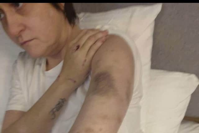 The injuries inflicted by Paul McCann on Erin Grigsby left her 'black and blue'