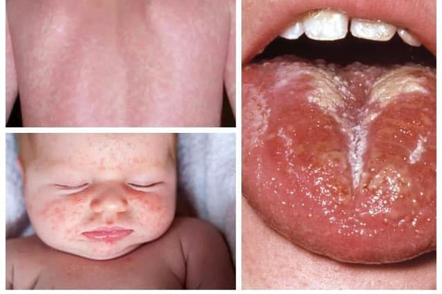 A rash and white coating on the tongue are symptoms of scarlet fever