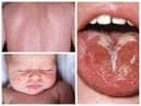 A rash and white coating on the tongue are symptoms of scarlet fever