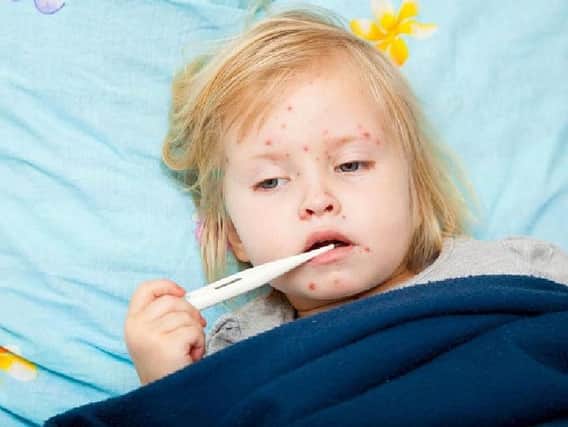 Symptoms include a high fever, watery eyes and a red brown rash