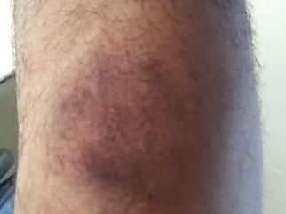 He said police officers beat him around the legs