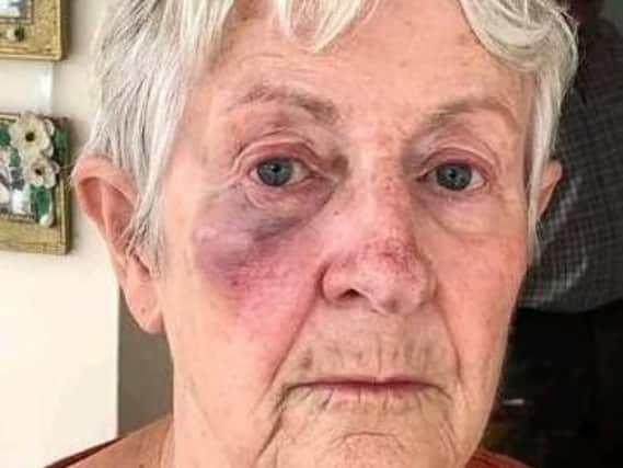 Jean Metcalfe tripped over discarded fencing in a public subway