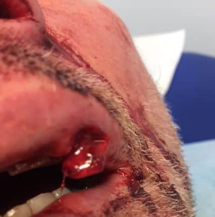 Peter Murphy's injured lip