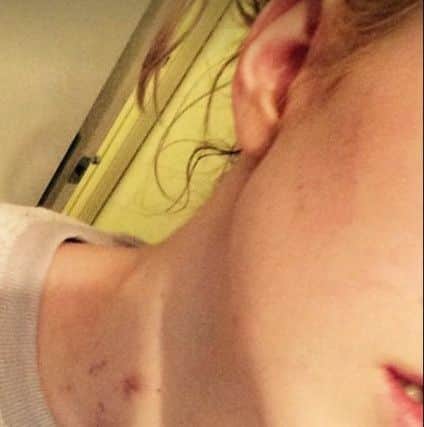 Bruises on Jodie's neck