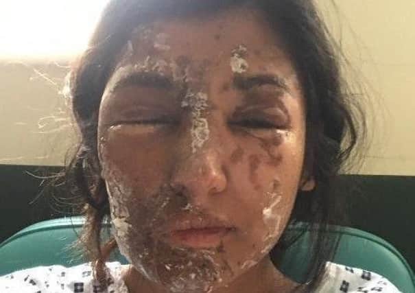 Acid attack victim Resham Khan